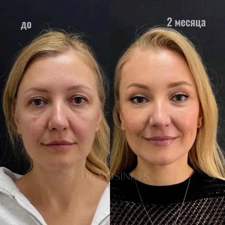Before and after deep plane facelift, frontal view by Dr. Vladimir Kosinets