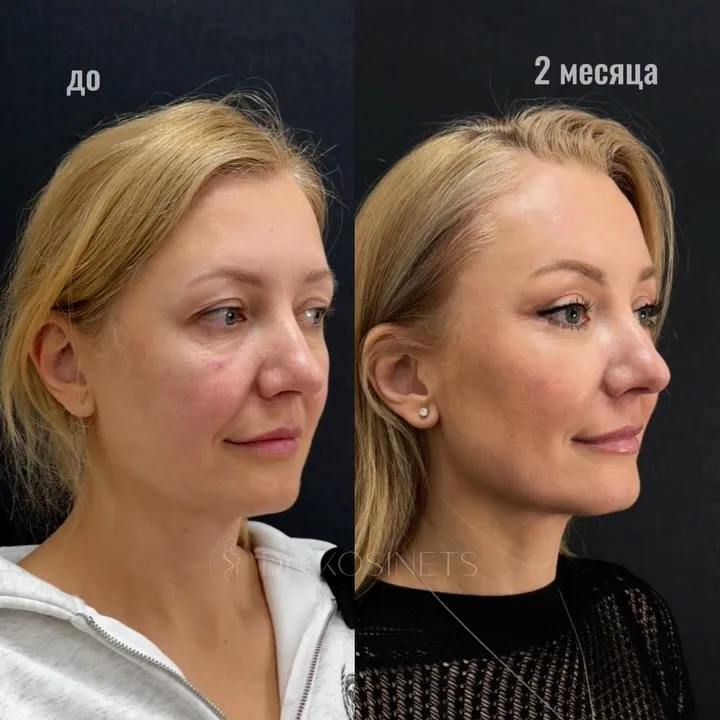 Before and after deep plane facelift, frontal view by Dr. Vladimir Kosinets