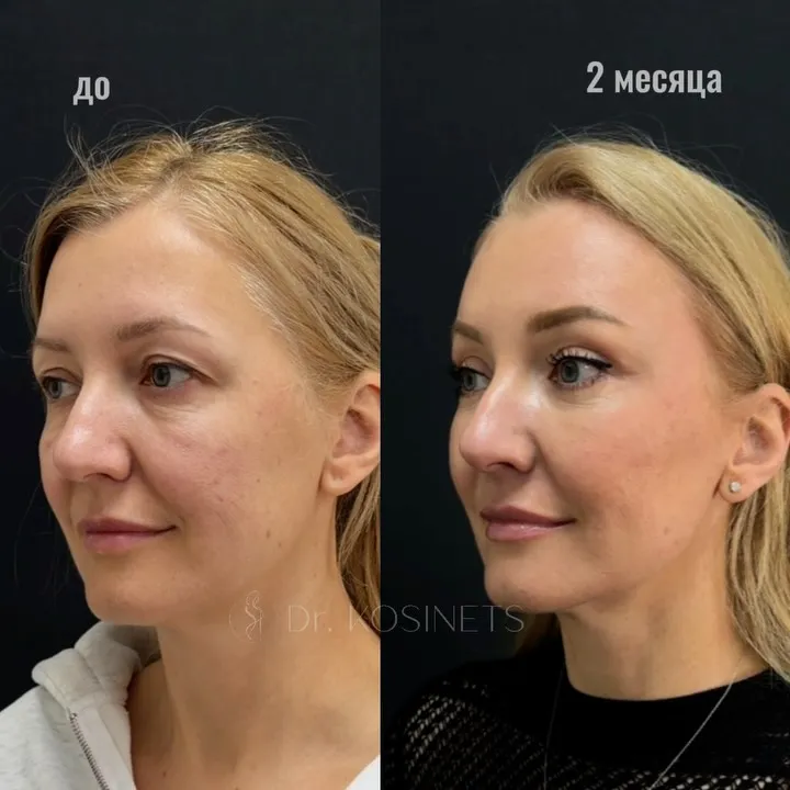 Before and after deep plane facelift, frontal view by Dr. Vladimir Kosinets