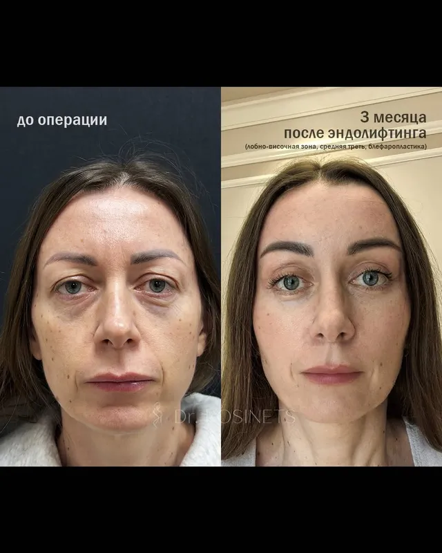 Before and after deep plane facelift, frontal view by Dr. Vladimir Kosinets