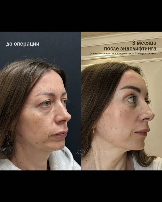 Before and after deep plane facelift, frontal view by Dr. Vladimir Kosinets