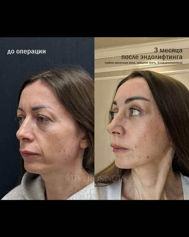 Before and after deep plane facelift, frontal view by Dr. Vladimir Kosinets