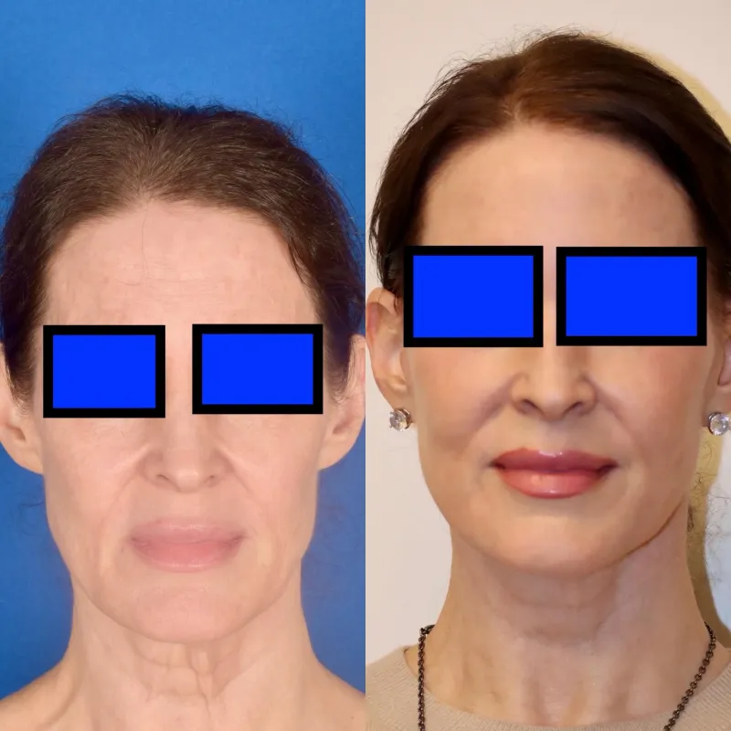 Before and after — Dr. Wayne Larrabee