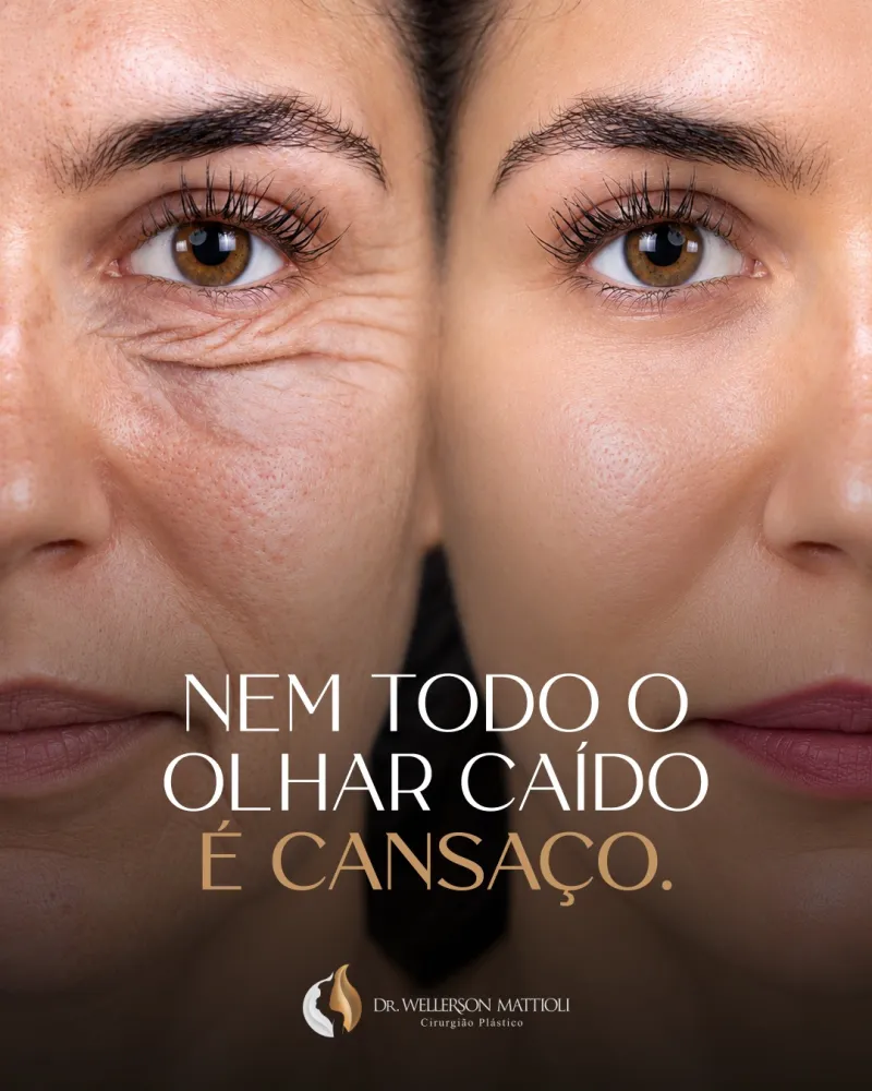 قبل وبعد - Lower Eyelid Surgery بواسطة د. Wellerson Mattioli