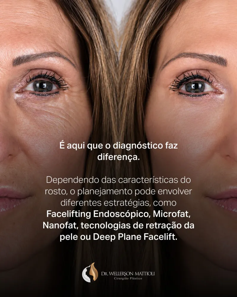 قبل وبعد - Deep Plane Facelift بواسطة د. Wellerson Mattioli