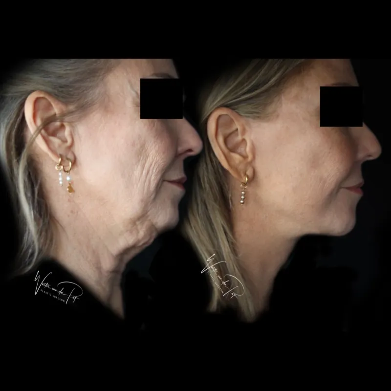 Before and after — Dr. Wouter van der Pot