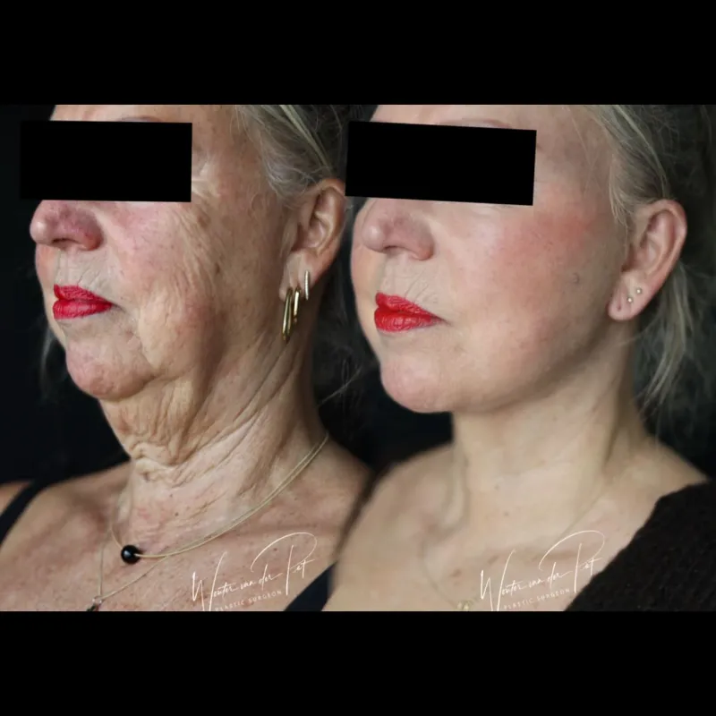 Before and after — Dr. Wouter van der Pot