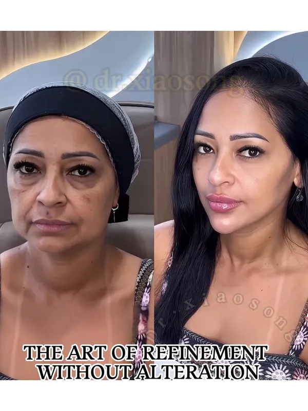 Before and after — Dr. Xiaosong Xiao