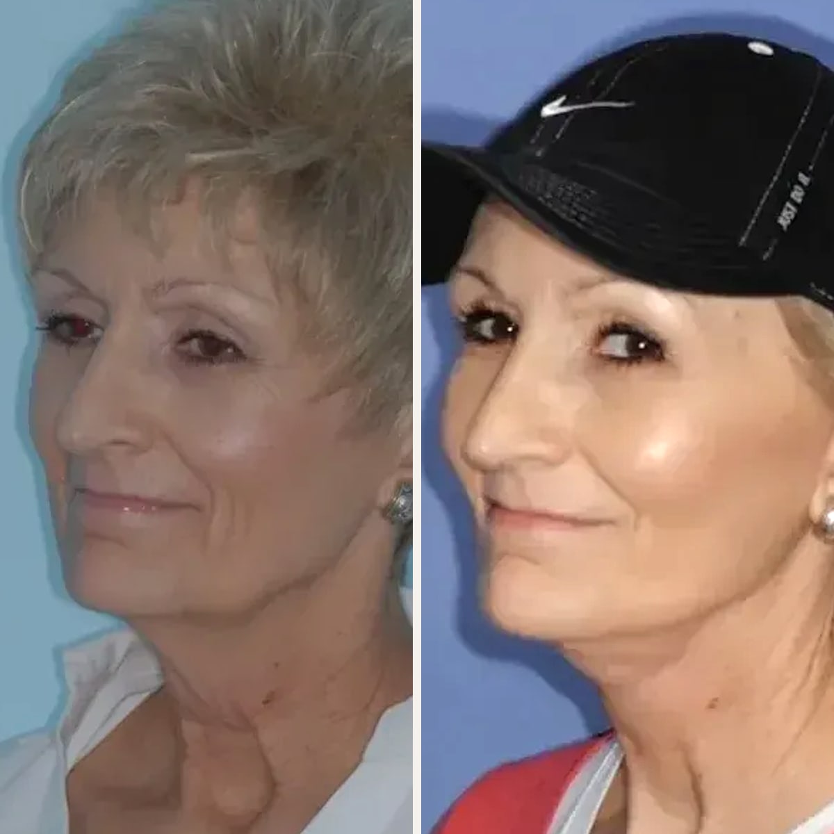 До и после — Deep Plane Facelift от доктора Yadranko Ducic