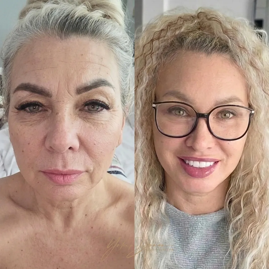Before and after deep plane facelift — 52-year-old woman, frontal view, 9mo post-op by Dr. Yakup Duman