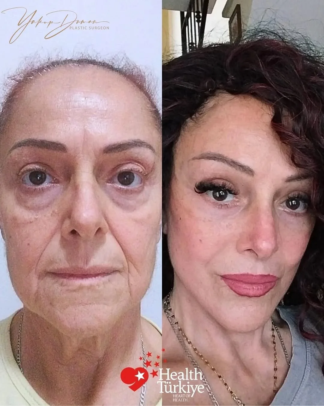 Before and after deep plane facelift — 55-year-old woman, frontal view, 1mo post-op by Dr. Yakup Duman