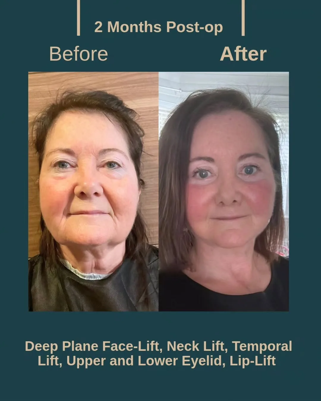 Before and after deep plane facelift — 58-year-old woman, frontal view, 2mo post-op by Dr. Yalçın Bayram