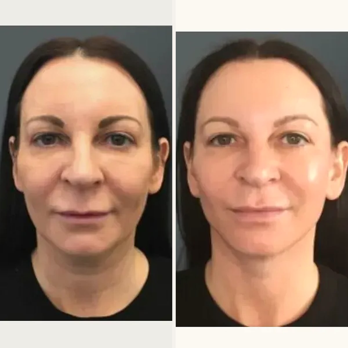 Before and after: Dr. Yannis Alexandrides