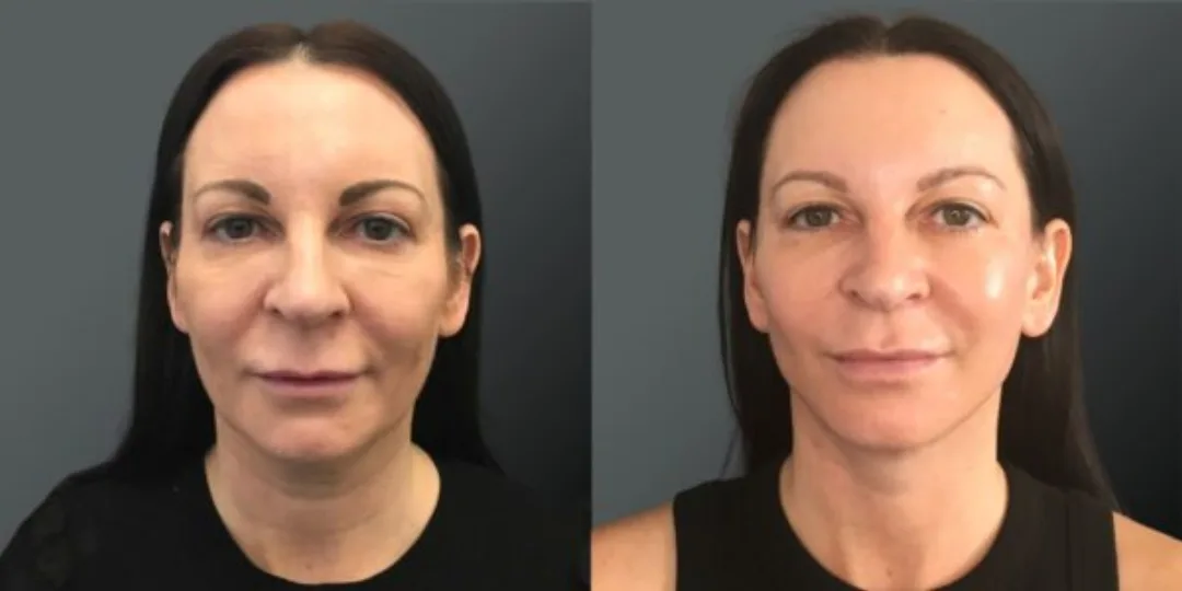 Before and after deep plane facelift — 45-year-old woman, oblique left view, 6mo post-op by Dr. Yannis Alexandrides