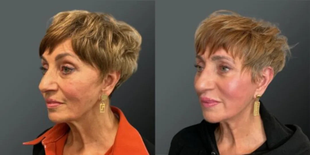 Before and after deep plane facelift — 58-year-old woman, left profile view, 6mo post-op by Dr. Yannis Alexandrides