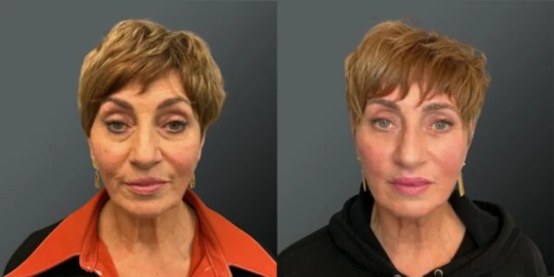 Before and after deep plane facelift — 58-year-old woman, frontal view, 7mo post-op by Dr. Yannis Alexandrides