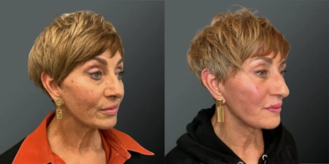 Before and after deep plane facelift — 55-year-old woman, oblique right view, 6mo post-op by Dr. Yannis Alexandrides