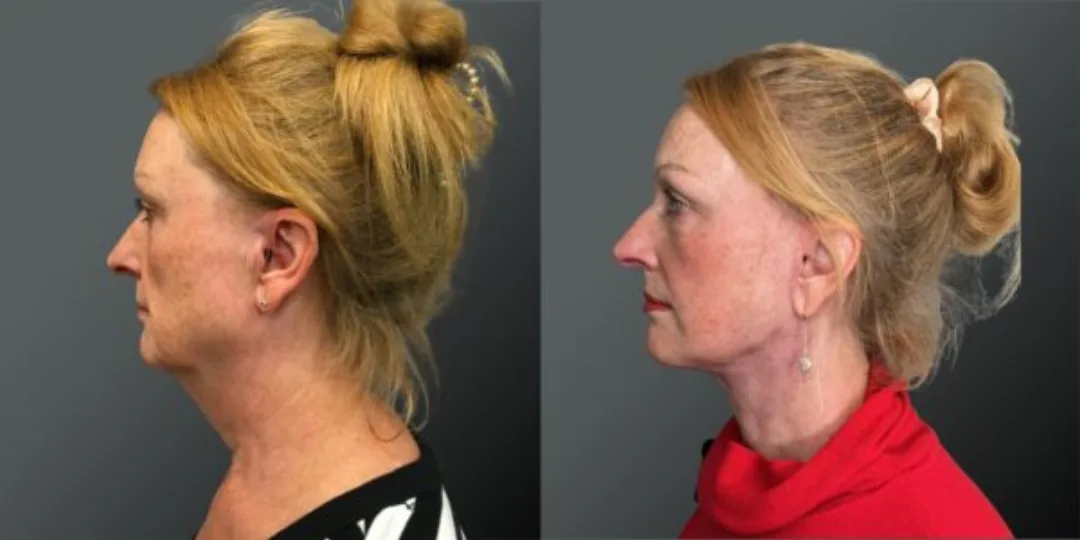 Before and after deep plane facelift — 45-year-old woman, left profile view, 6mo post-op by Dr. Yannis Alexandrides