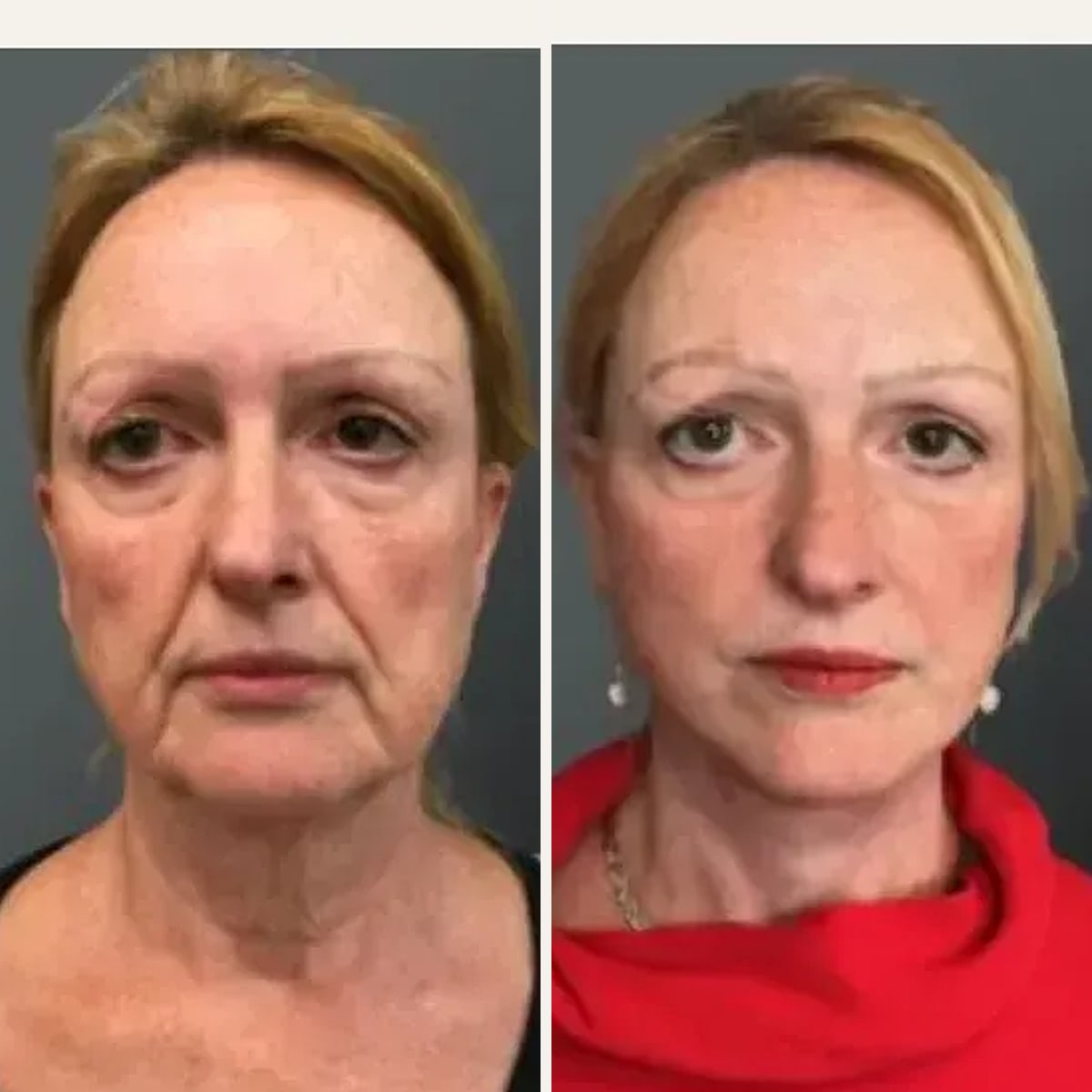 Before and after: Dr. Yannis Alexandrides