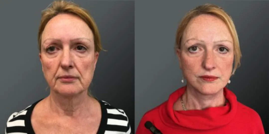 Before and after deep plane facelift — 58-year-old woman, oblique right view, 6mo post-op by Dr. Yannis Alexandrides