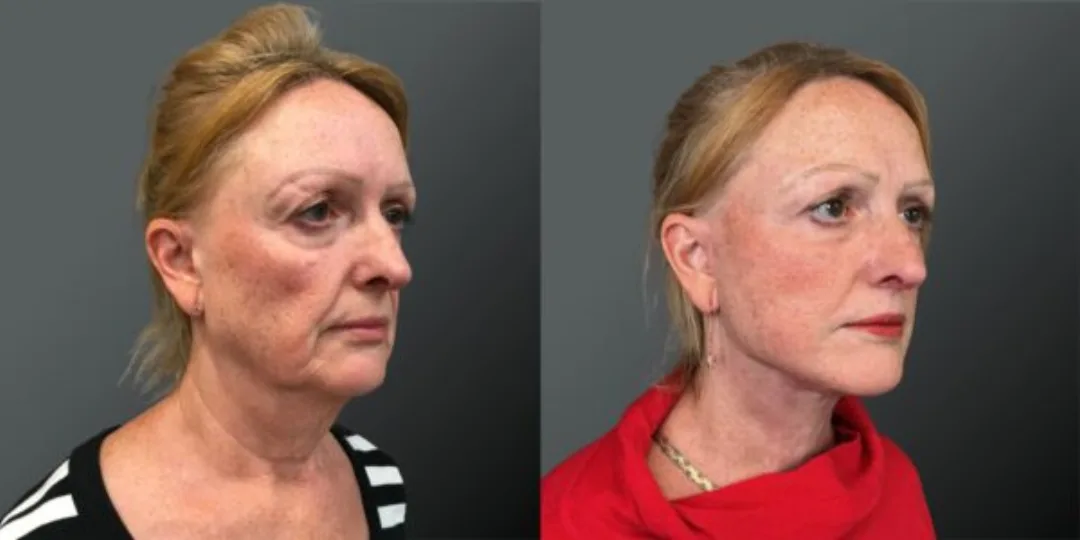 Before and after deep plane facelift — 52-year-old woman, oblique right view, 8mo post-op by Dr. Yannis Alexandrides