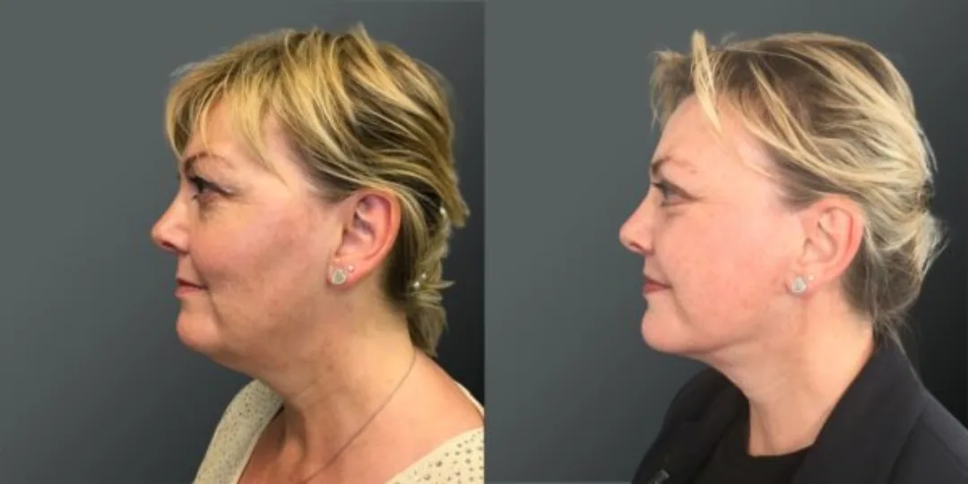 Before and after deep plane facelift — 55-year-old woman, left profile view, 6mo post-op by Dr. Yannis Alexandrides