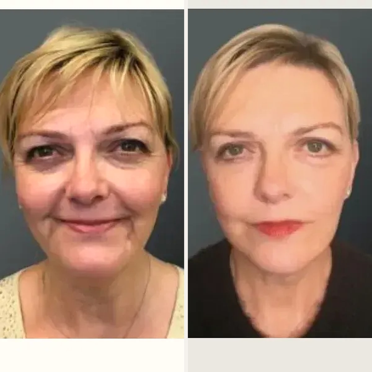 Before and after: Dr. Yannis Alexandrides
