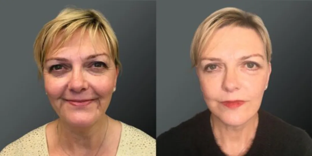 Before and after deep plane facelift — 55-year-old woman, frontal view, 6mo post-op by Dr. Yannis Alexandrides