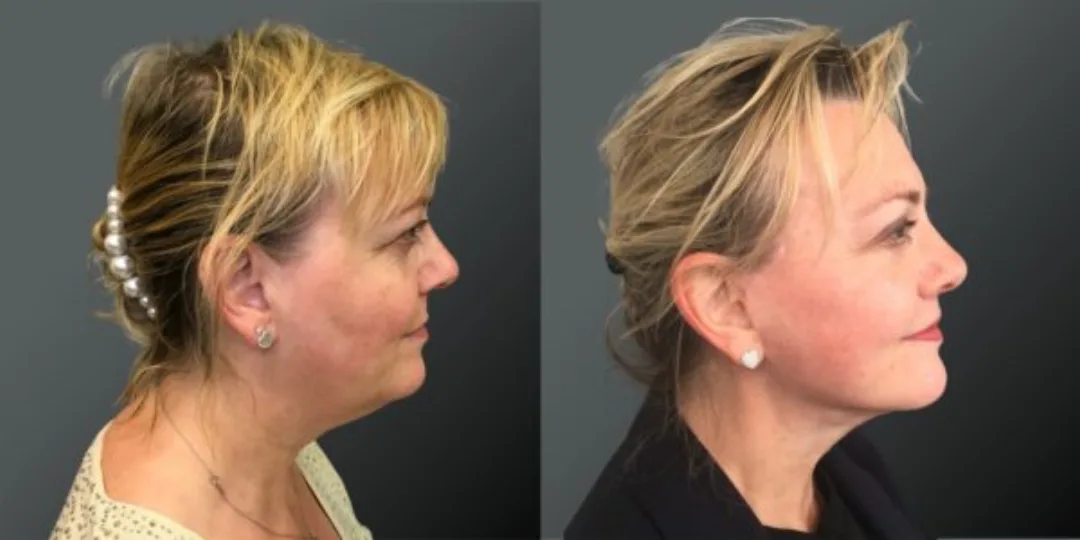 Before and after deep plane facelift — 52-year-old woman, right profile view, 8mo post-op by Dr. Yannis Alexandrides