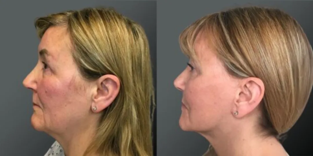 Before and after deep plane facelift — 45-year-old woman, left profile view, 6mo post-op by Dr. Yannis Alexandrides