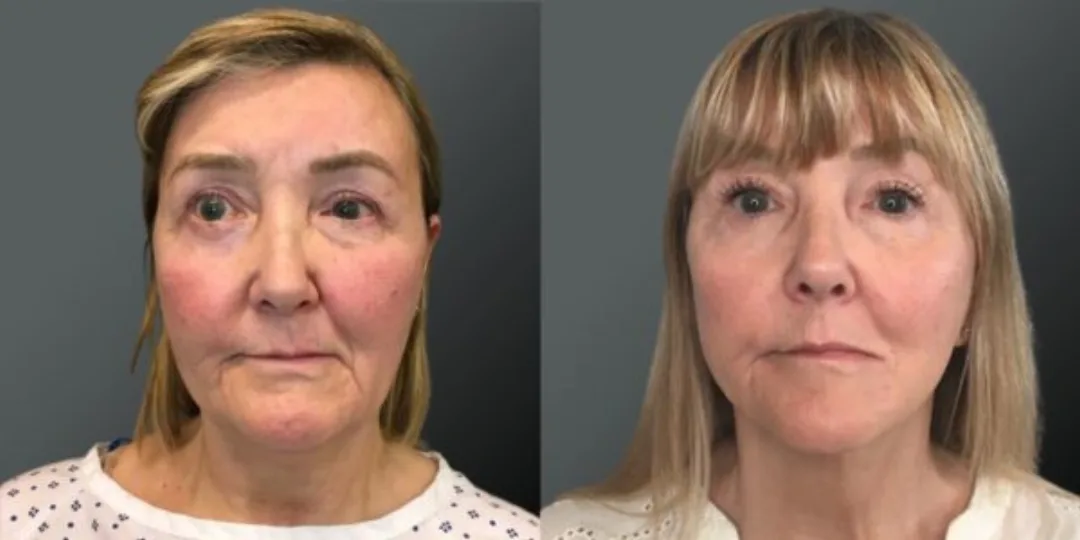 Before and after deep plane facelift — 55-year-old woman, oblique left view, 9mo post-op by Dr. Yannis Alexandrides