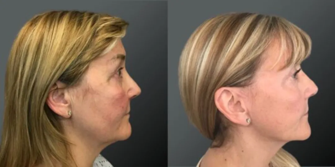 Before and after deep plane facelift — 55-year-old woman, right profile view, 6mo post-op by Dr. Yannis Alexandrides