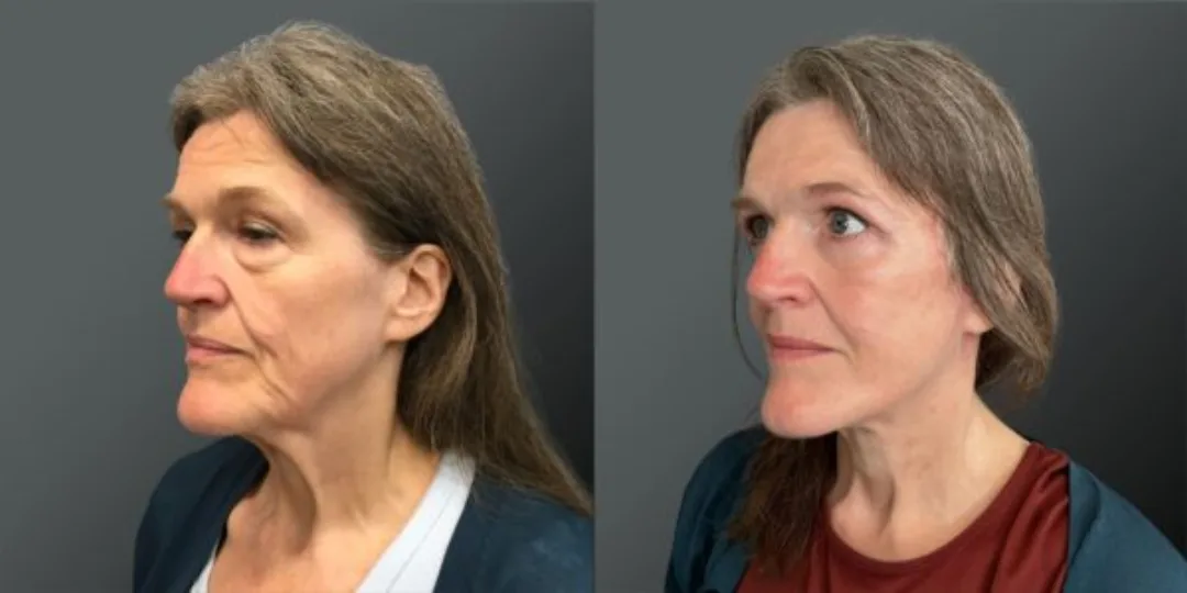 Before and after deep plane facelift — 55-year-old woman, oblique left view, 6mo post-op by Dr. Yannis Alexandrides