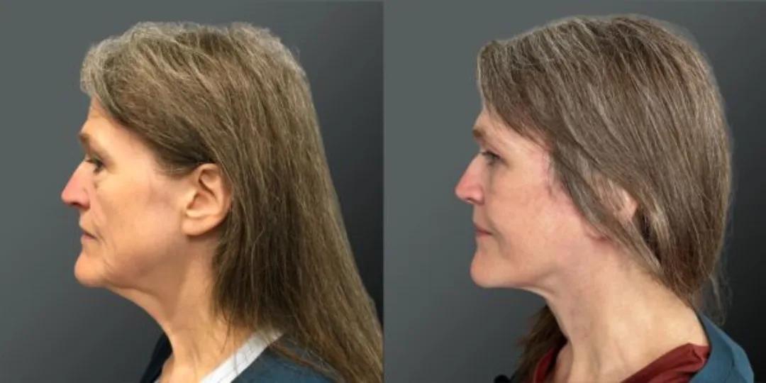 Before and after deep plane facelift — 52-year-old woman, left profile view, 6mo post-op by Dr. Yannis Alexandrides