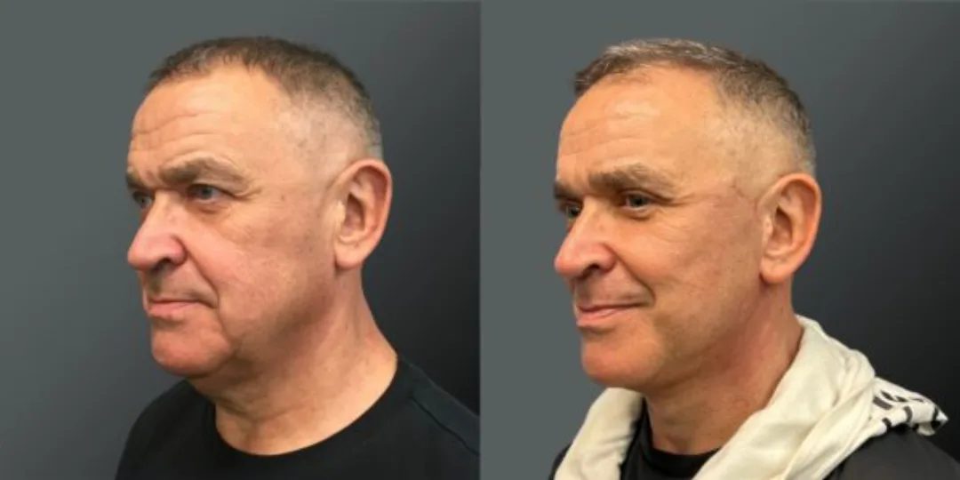 Before and after deep plane facelift — 55-year-old man, right profile view, 6mo post-op by Dr. Yannis Alexandrides