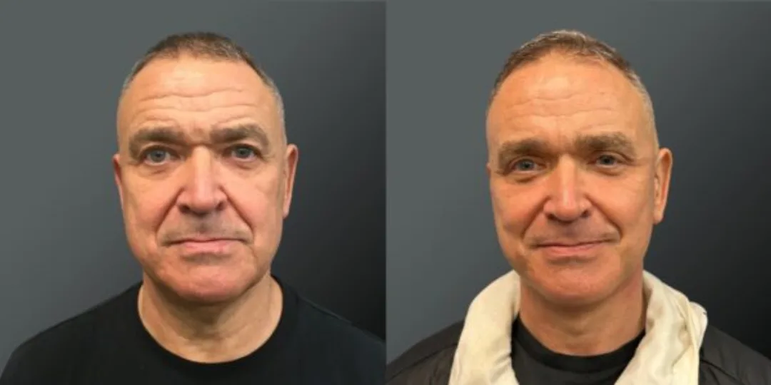 Before and after deep plane facelift — 55-year-old man, oblique right view, 6mo post-op by Dr. Yannis Alexandrides