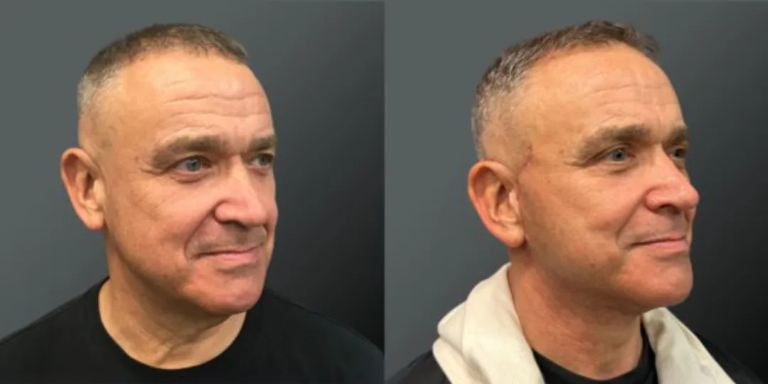 Before and after deep plane facelift — 55-year-old man, oblique right view, 6mo post-op by Dr. Yannis Alexandrides