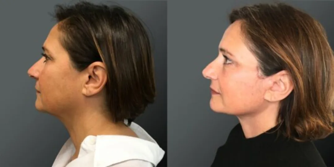 Before and after deep plane facelift — 42-year-old woman, left profile view, 6mo post-op by Dr. Yannis Alexandrides