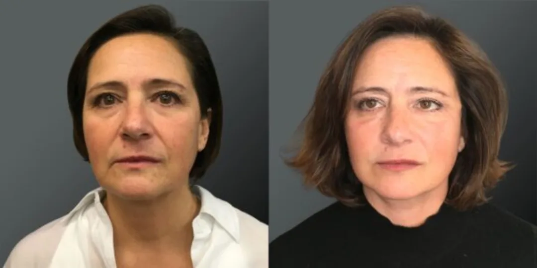 Before and after deep plane facelift — 48-year-old woman, oblique right view, 6mo post-op by Dr. Yannis Alexandrides