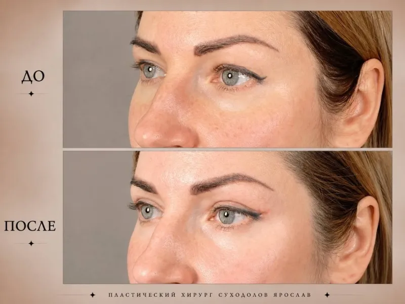 قبل وبعد - Lower Eyelid Surgery بواسطة د. Ярослав Суходолов