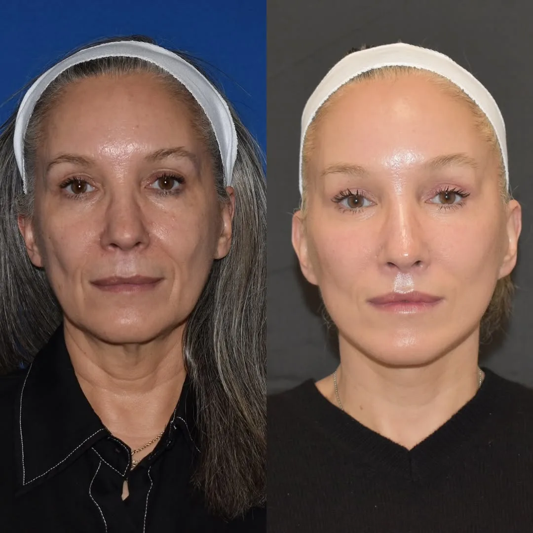 Before and after deep plane facelift — 48-year-old woman, frontal view, 4mo post-op by Dr. Yula Indeyeva