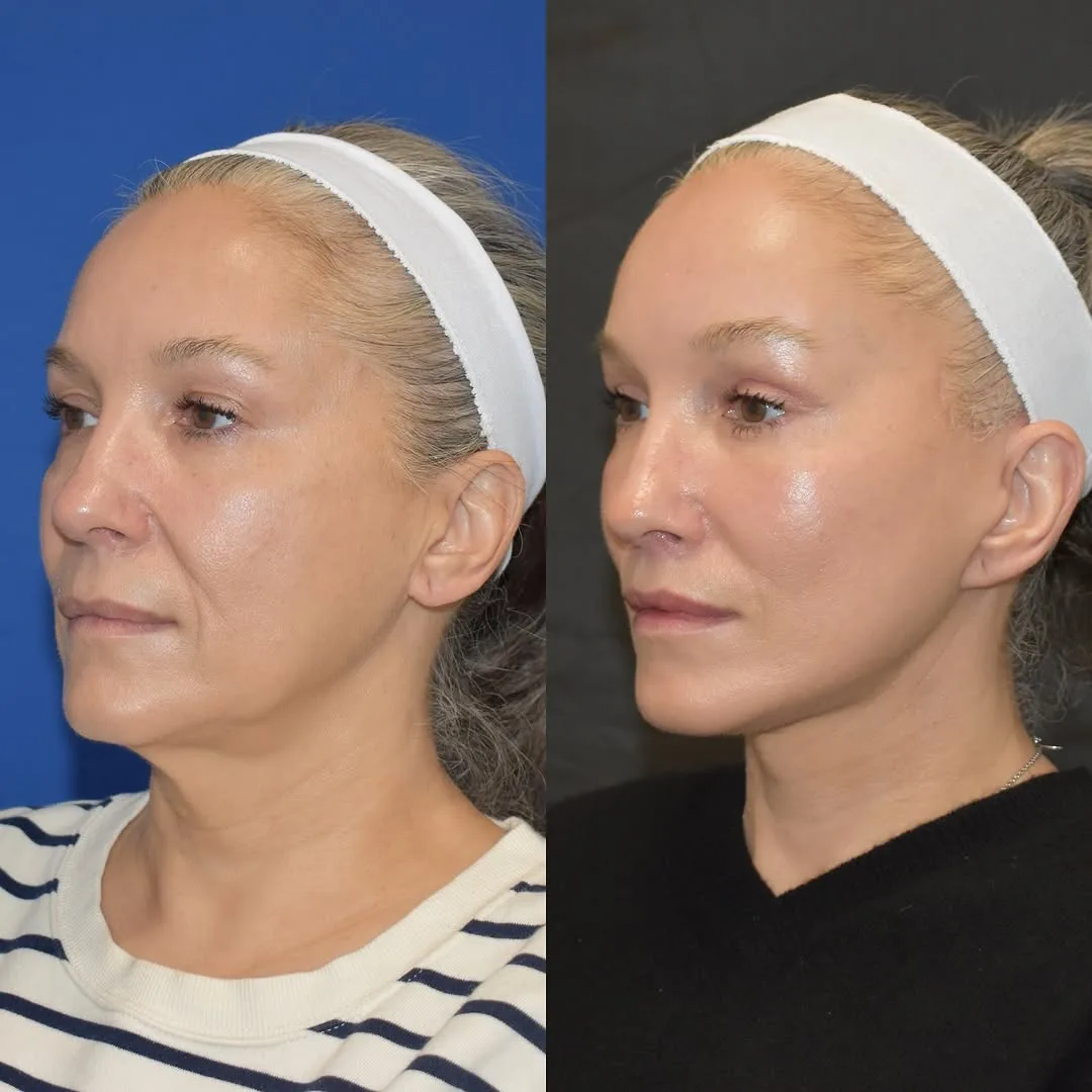 Before and after deep plane facelift — 48-year-old woman, three-quarter view, 4mo post-op by Dr. Yula Indeyeva