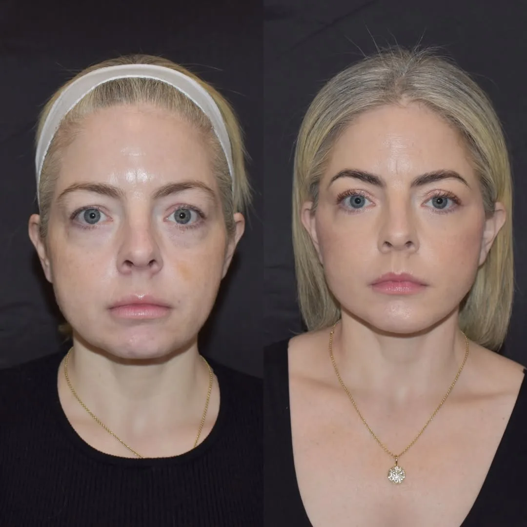 Before and after deep plane facelift — 42-year-old woman, frontal view, 7mo post-op by Dr. Yula Indeyeva