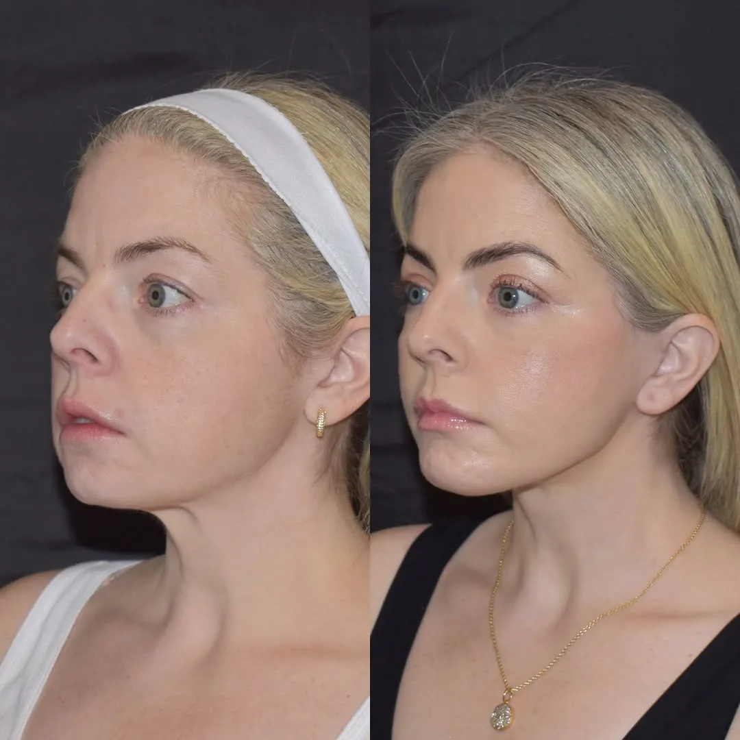 Before and after deep plane facelift — 35-year-old woman, three-quarter view, 6mo post-op by Dr. Yula Indeyeva