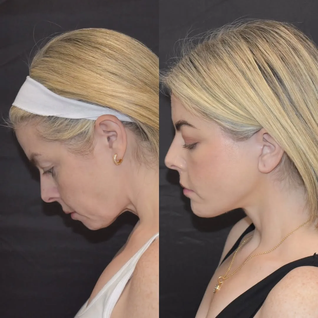 Before and after deep plane facelift — 45-year-old woman, right profile view, 6mo post-op by Dr. Yula Indeyeva