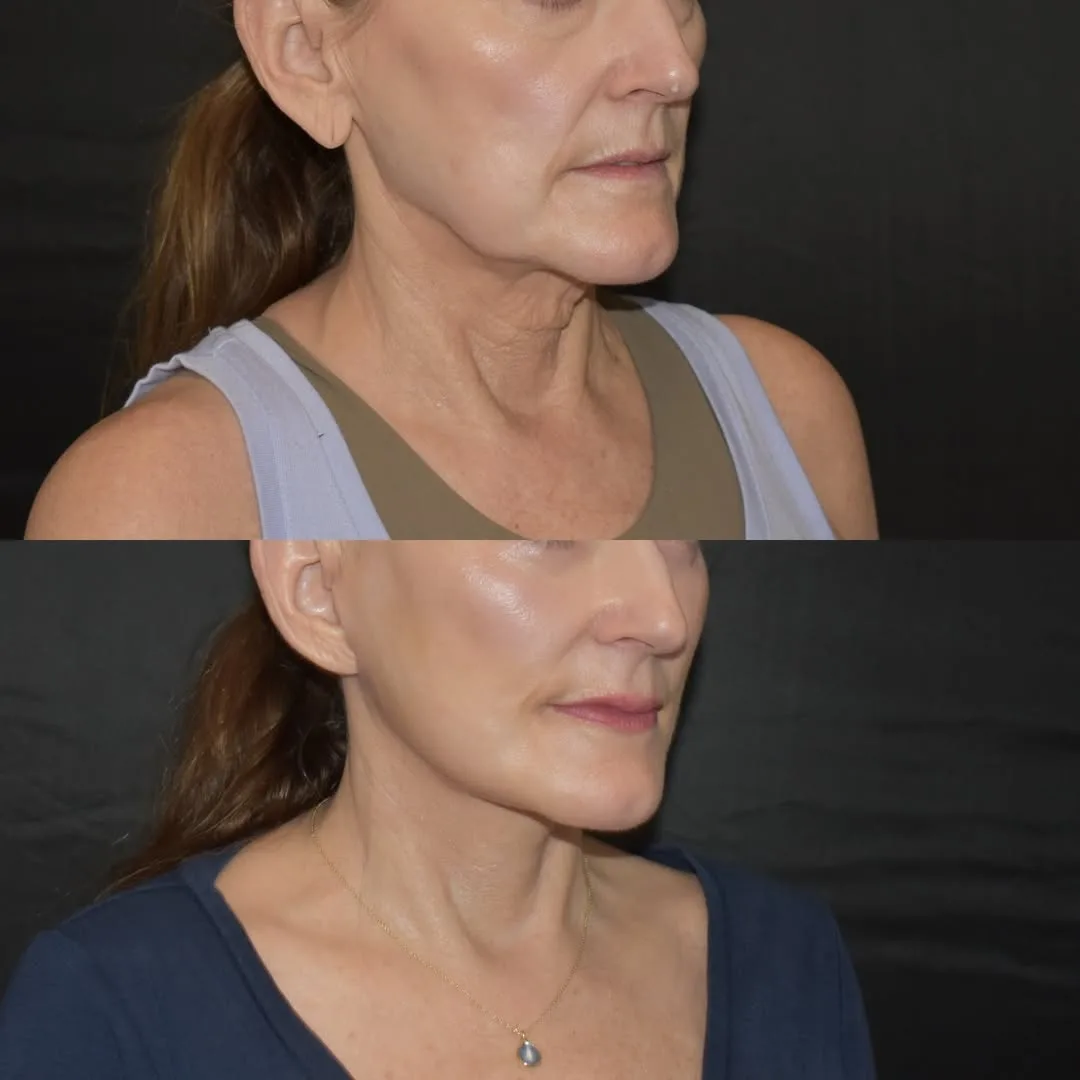 Before and after deep plane facelift — 55-year-old woman, three-quarter view, 2mo post-op by Dr. Yula Indeyeva