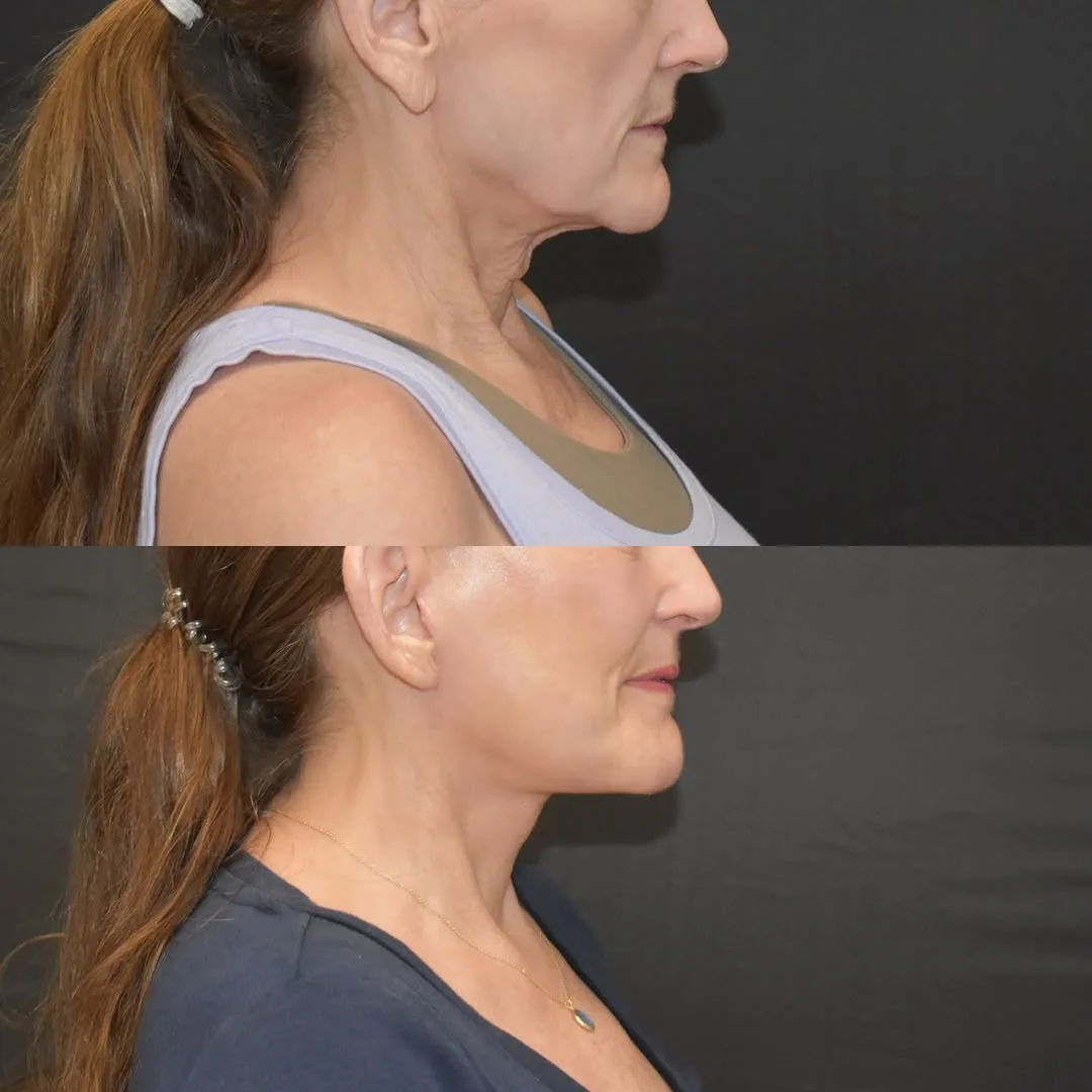 Before and after deep plane facelift — 52-year-old woman, three-quarter view, 2mo post-op by Dr. Yula Indeyeva
