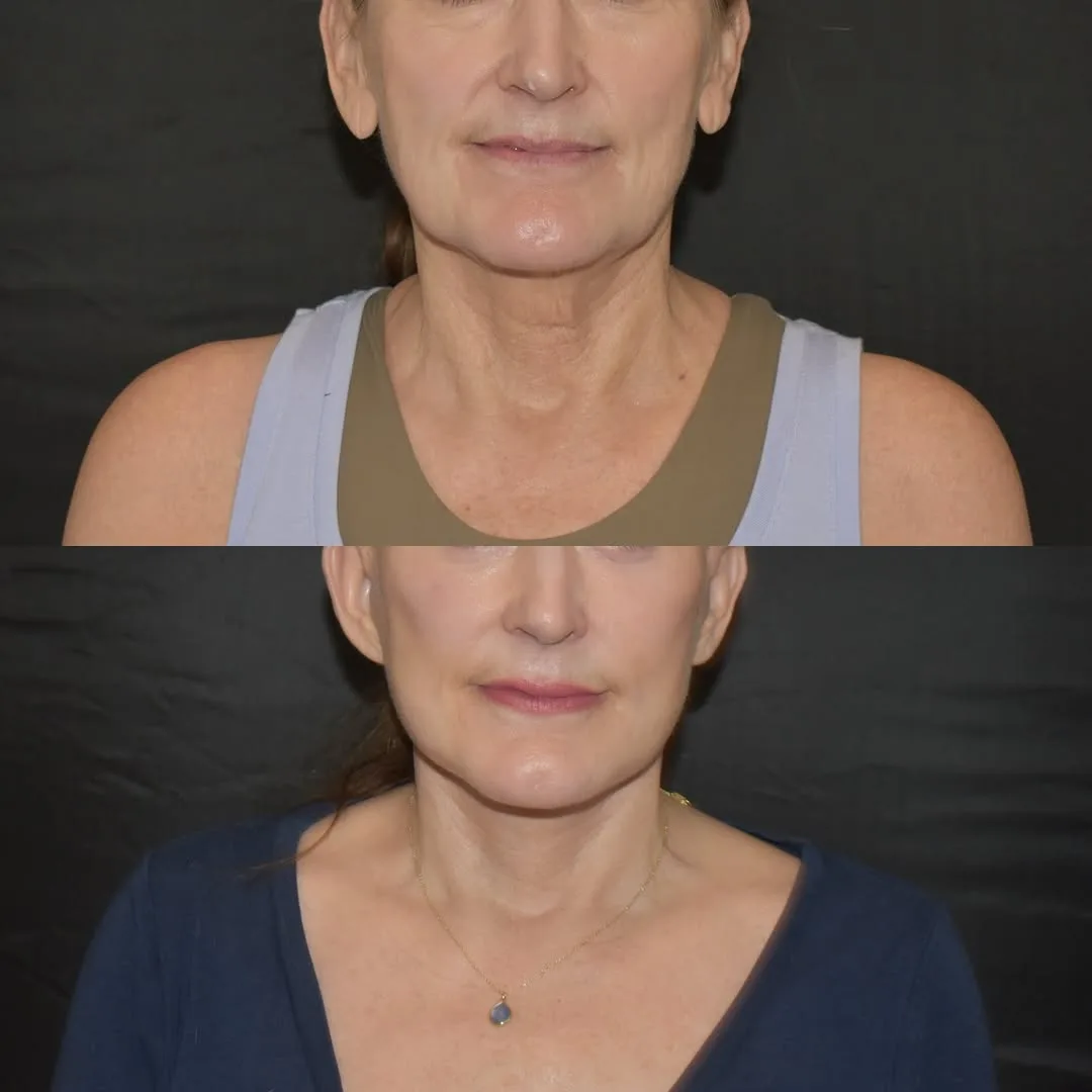 Before and after deep plane facelift — 55-year-old woman, frontal view, 2mo post-op by Dr. Yula Indeyeva