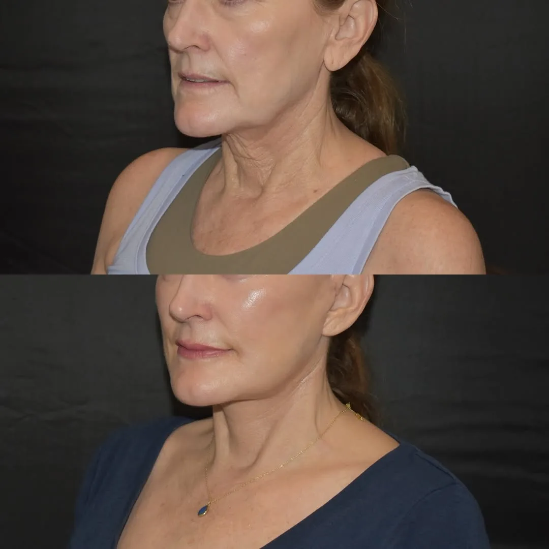Before and after deep plane facelift — 55-year-old woman, three-quarter view, 2mo post-op by Dr. Yula Indeyeva