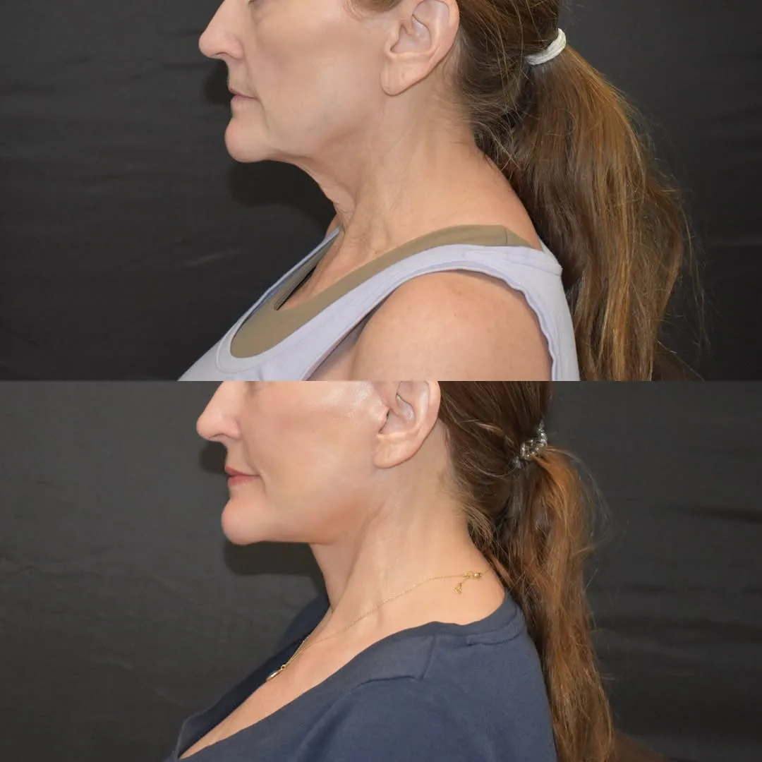 Before and after deep plane facelift — 55-year-old woman, left profile view, 2mo post-op by Dr. Yula Indeyeva